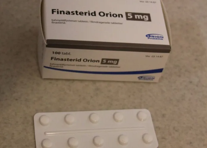 Finasteride Side Effects: Man's Regret After Hair Loss Drug