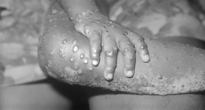 Monkeypox Screening Intensified as New Variant Threatens