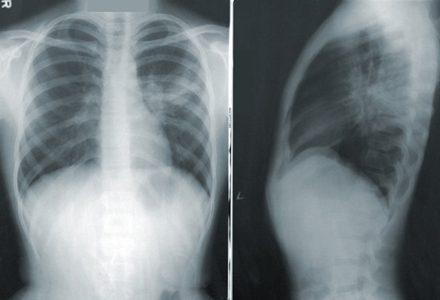 AI-Powered X-Ray Diagnoses TB in 5 Minutes at Qatar Hospital