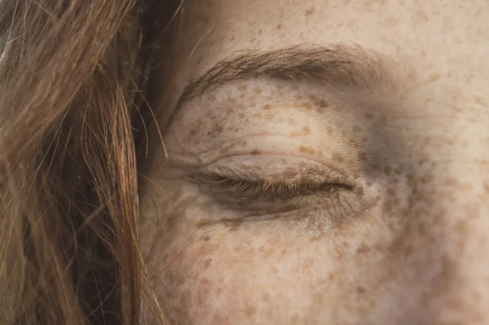 UK Melanoma Cases Hit Record High as Skin Cancer Diagnoses Top 20,000