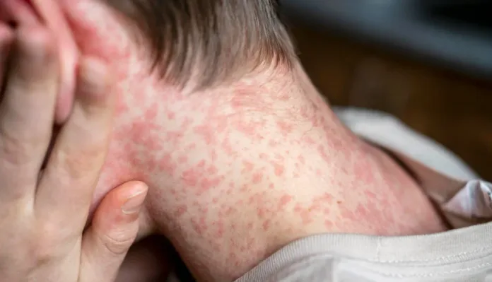 England Measles Outbreak: Two Children Die as Cases Rise