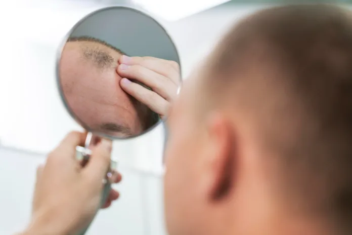 Person examining thinning hair in a mirror as research links GLP-1 hair loss to weight loss drugs including Wegovy, Ozempic and Mounjaro