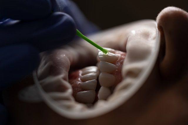 Extreme Dental Fear Leads Woman to Superglue Her Teeth