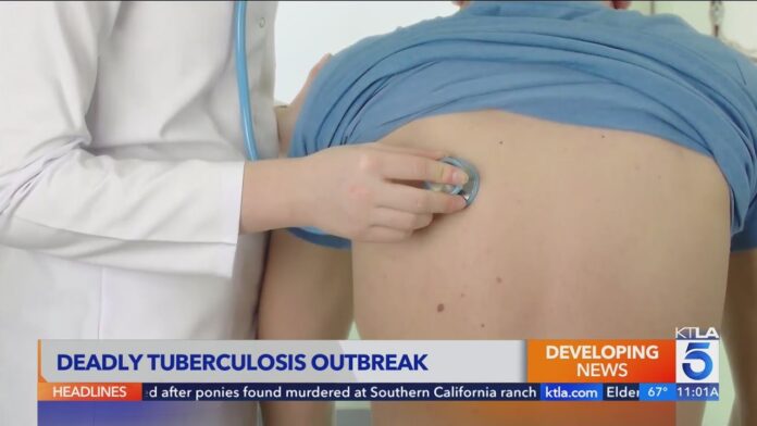 Tuberculosis Outbreak Declared in Long Beach, Low Risk to Public