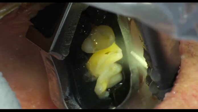 World's First Fully Automated Dental Procedure by Robot